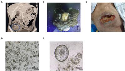 Organoids From Mucinous Appendiceal Adenocarcinomas as High-Fidelity Models for Individual Therapy